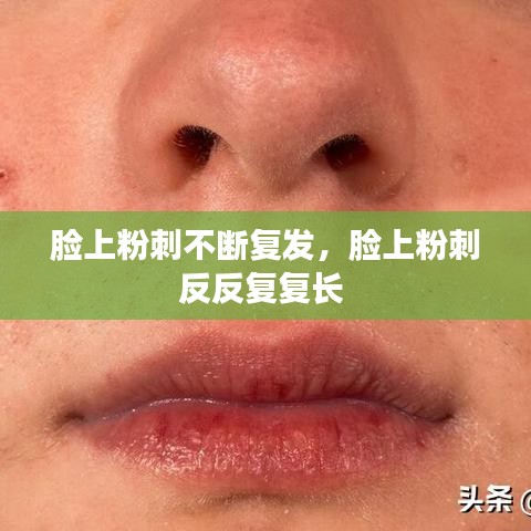脸上粉刺不断复发，脸上粉刺反反复复长 